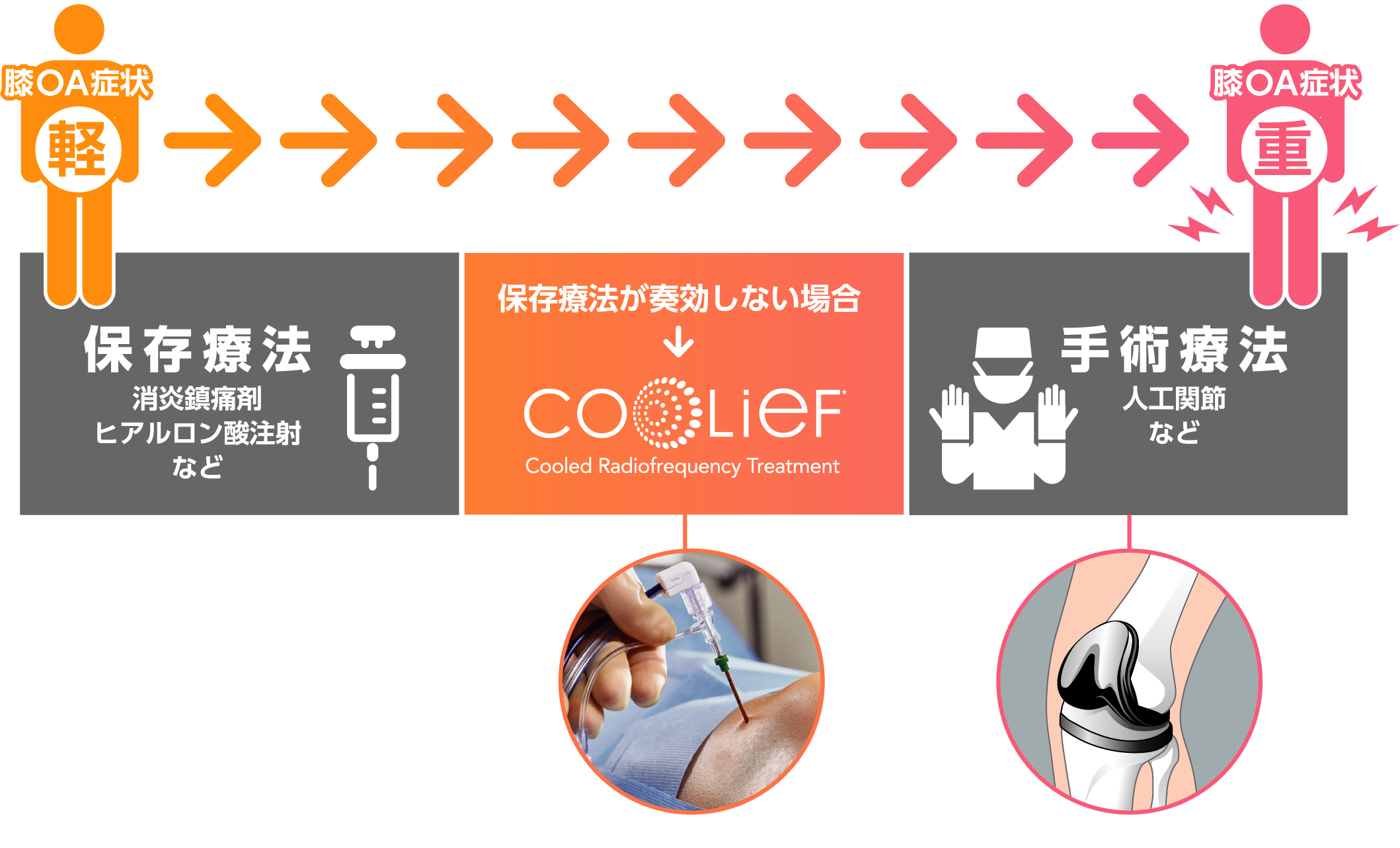 Coolief疼痛管理用高周波システム