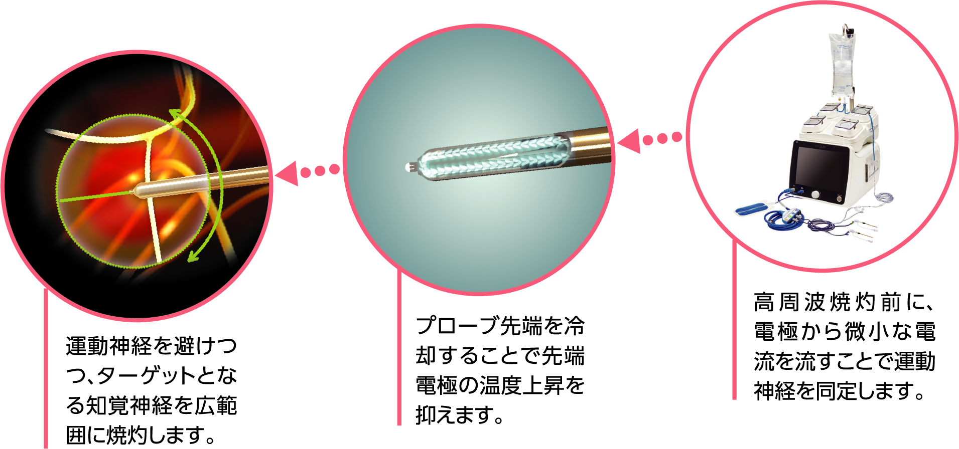 Coolief疼痛管理用高周波システム